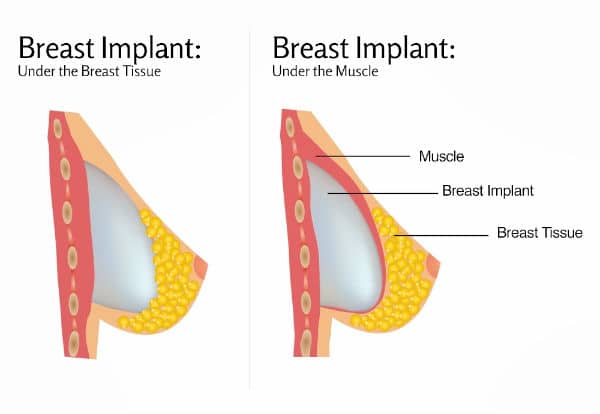 Affordable Breast Augmentation Without Surgery