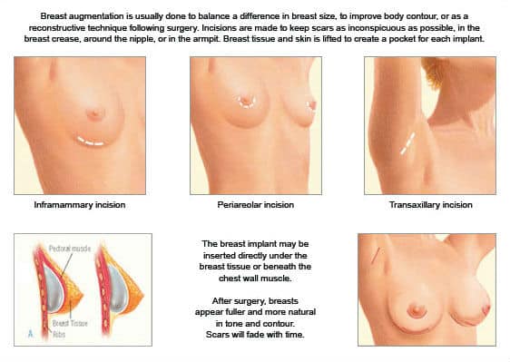 breast-surgery-incisions